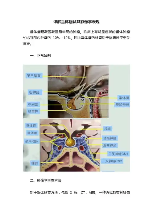 详解垂体瘤及其影像学表现