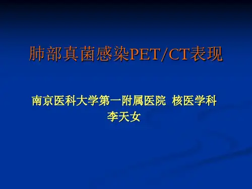 肺部真菌感染的PET-CT表现