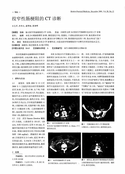 绞窄性肠梗阻的CT诊断
