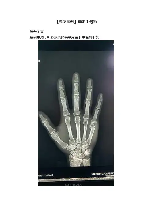 【典型病例】拳击手骨折
