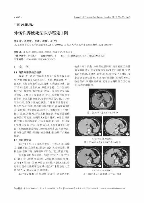 外伤性脾梗死法医学鉴定1例