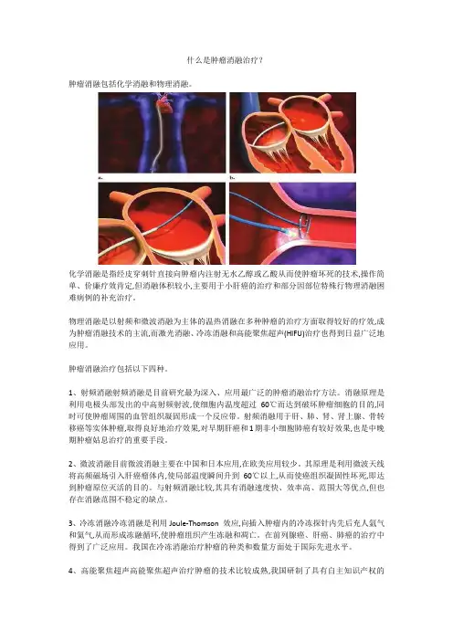 什么是肿瘤消融治疗？