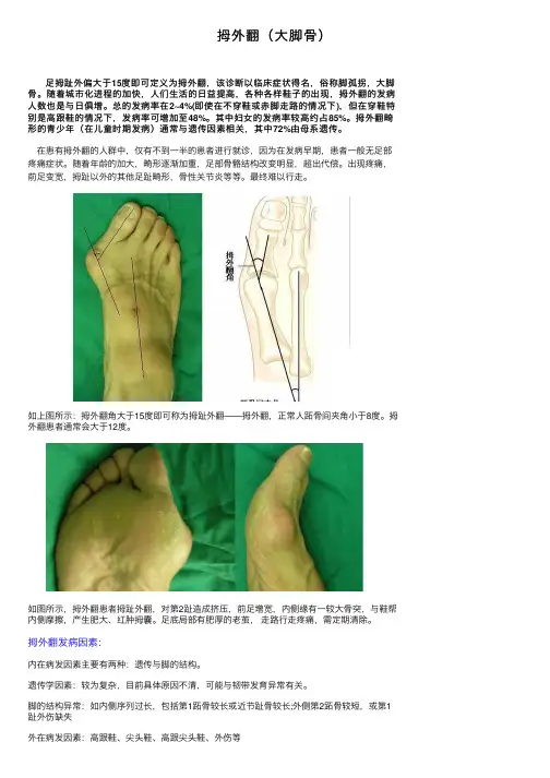 拇外翻（大脚骨）