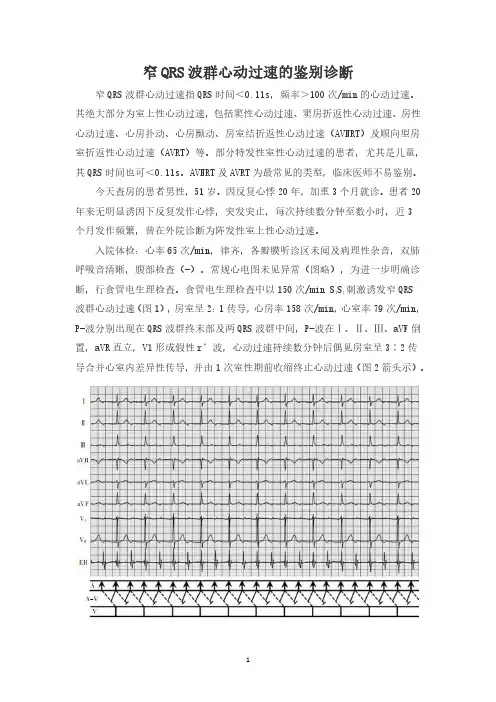 窄QRS波群心动过速的鉴别诊断