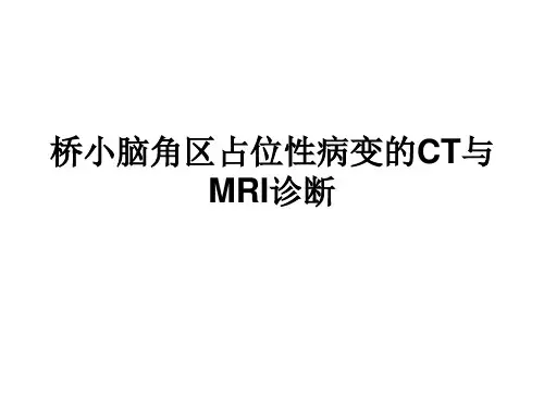 桥小脑角区占位性病变的ct与mri诊断 ppt课件