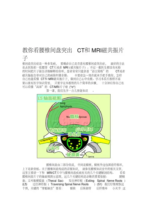 十分钟学会看懂腰椎间盘突出CT及MRI教程