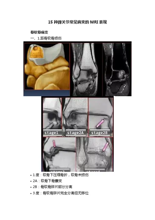 15种踝关节常见病变的MRI表现