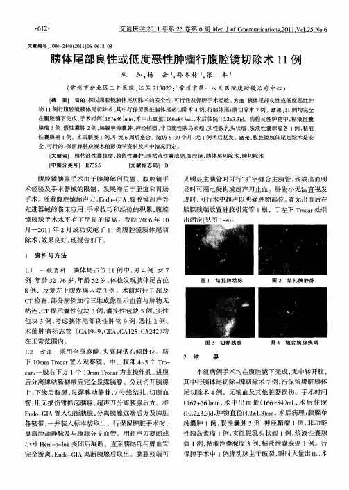 胰体尾部良性或低度恶性肿瘤行腹腔镜切除术11例