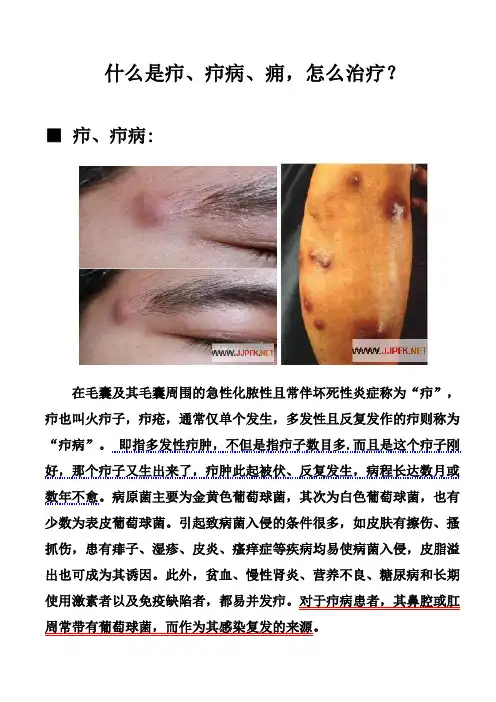 什么是疖(毛囊炎)、疖病、痈,怎么治疗