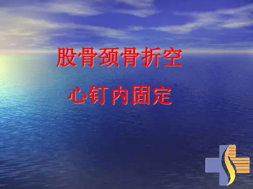 股骨颈骨折空心钉内固定选择.ppt