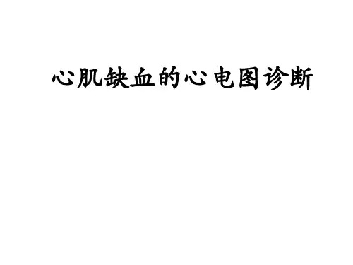 心肌缺血心电图