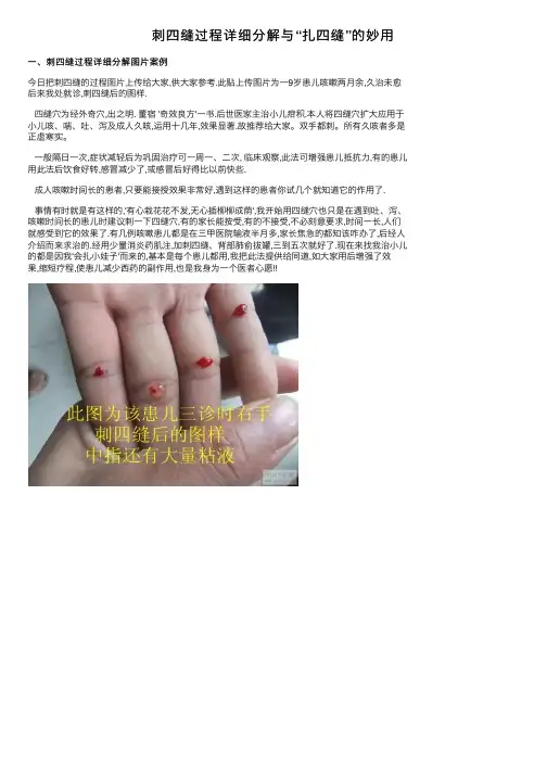 刺四缝过程详细分解与“扎四缝”的妙用