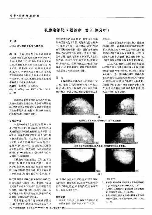 乳腺癌钼靶X线诊断(附90例分析)