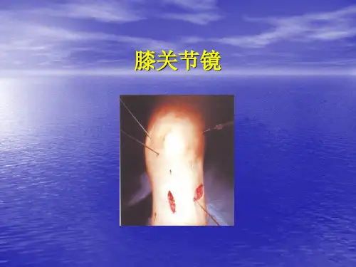 膝关节镜PPT课件