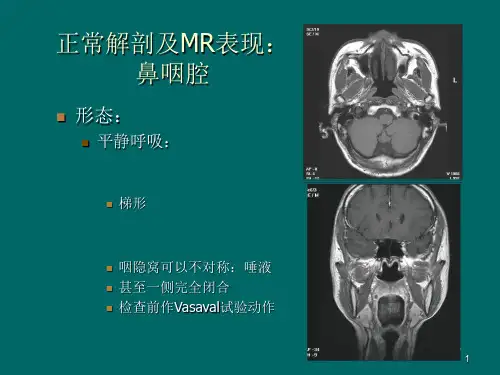 鼻咽癌MR诊断 ppt课件
