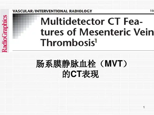 肠系膜静脉血栓(MVT)的CT表现PPT医学课件