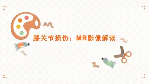 膝关节损伤的MR影像解读