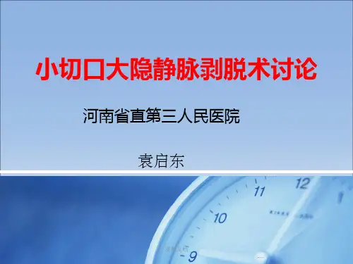 大隐静脉曲张剥脱术