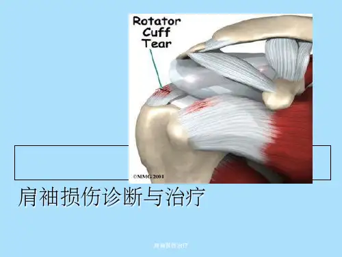 肩袖损伤治疗