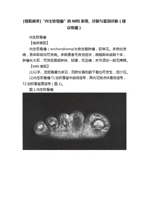 [骨肌病变]“内生软骨瘤”的MRI表现、诊断与鉴别诊断（建议收藏）