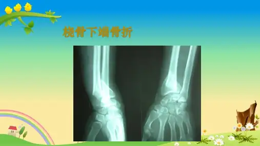 精品中医PPT课件：桡骨远端骨折