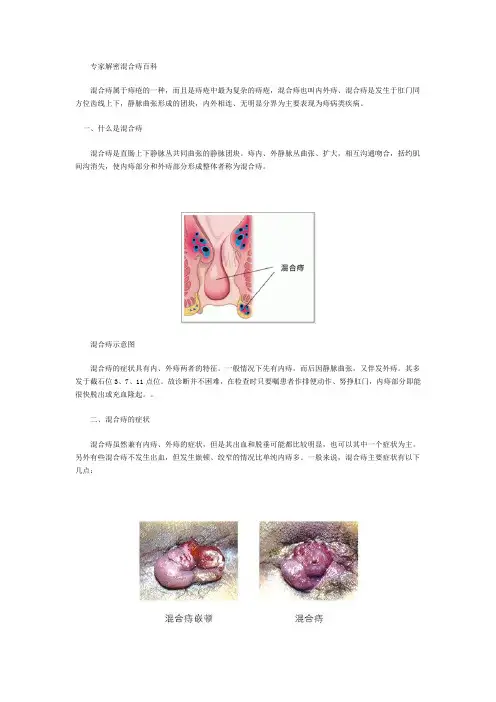解密混合痔百科[附实图]
