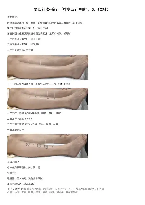 舒氏针法--金针（排寒五针中的1、3、4位针）