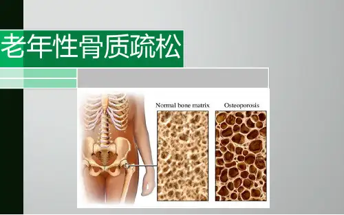 老年性骨质疏松(ppt)【33页】