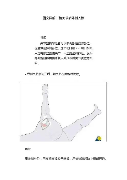 图文详解：髋关节后外侧入路
