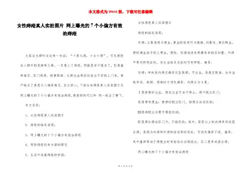 女性痔疮真人实拍图片 网上曝光的7个小偏方有效治痔疮
