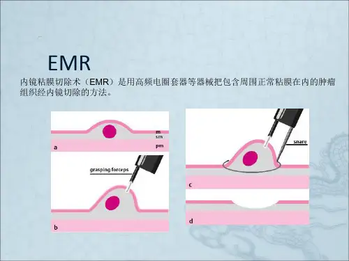 内镜下EMR