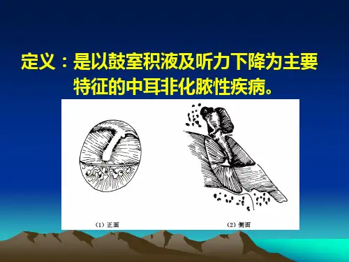分泌型中耳炎SecretoryOtitisMedia