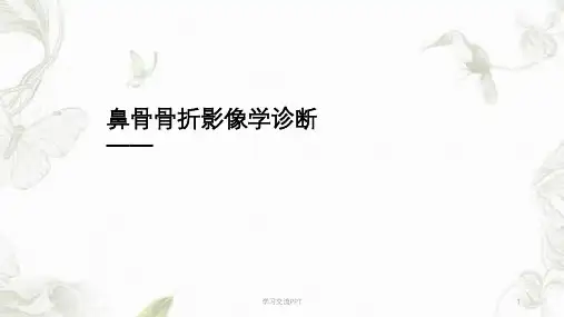 鼻骨骨折的影像诊断课件