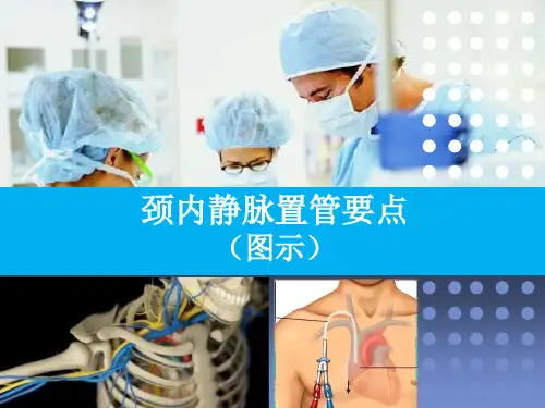 颈内静脉置管