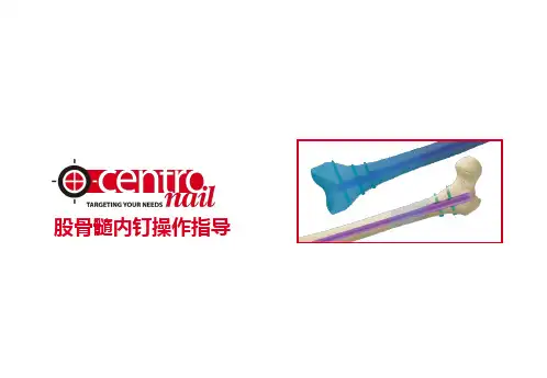股骨髓内钉操作指导课件