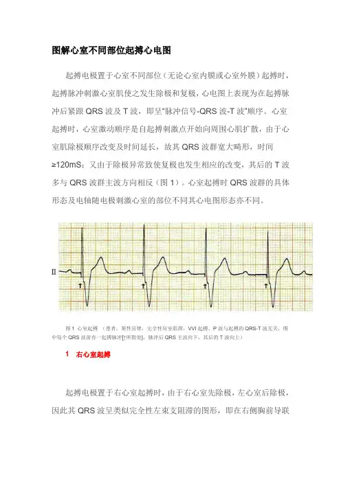 图解心室不同部位起搏心电图