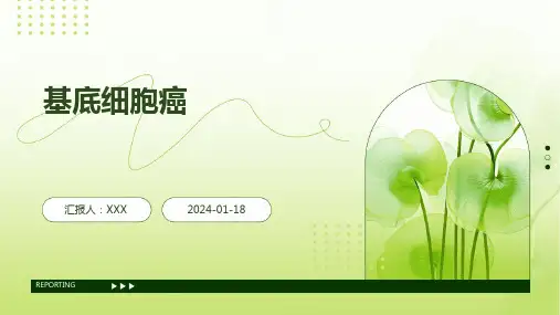 基底细胞癌汇报ppt课件
