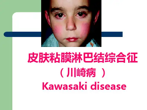 优质PPT课件推选皮肤粘膜淋巴结综合征1川崎病.ppt模板