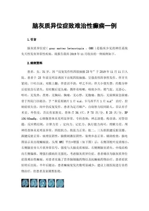 脑灰质异位症致难治性癫痫一例