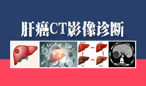 肝癌CT影像诊断