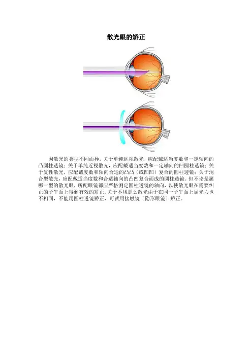 散光眼的矫正