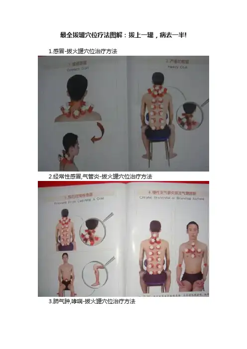 最全拔罐穴位疗法图解：拔上一罐，病去一半!