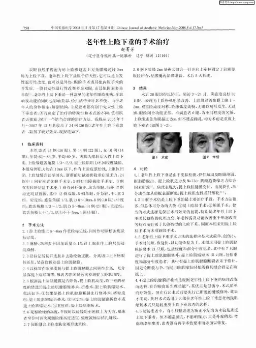 老年性上睑下垂的手术治疗