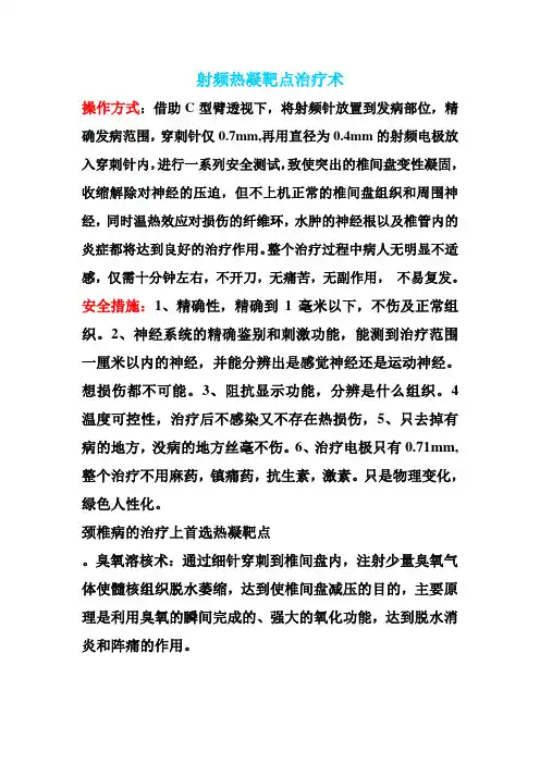射频热凝靶点治疗术