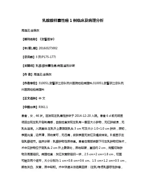 乳腺腺样囊性癌1例临床及病理分析