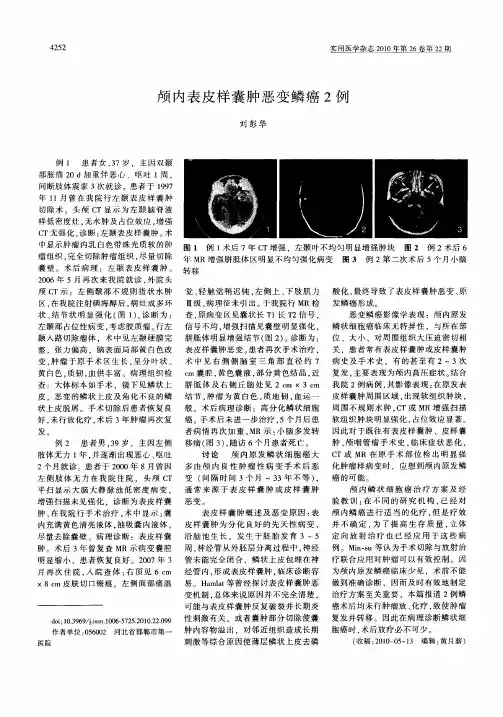 颅内表皮样囊肿恶变鳞癌2例