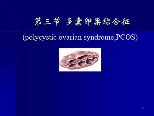 多囊卵巢综合征-精品医学课件