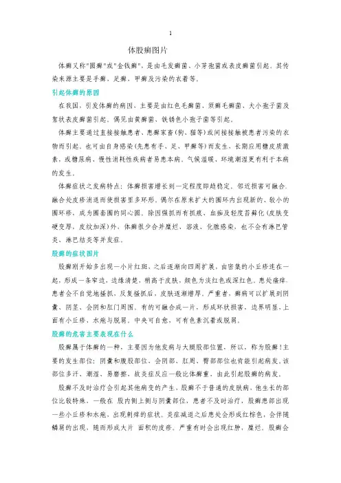 体股癣图片