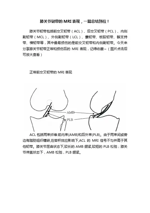 膝关节韧带的MRI表现，一篇总结到位！
