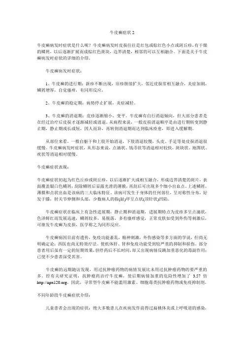 牛皮癣症状2